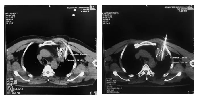 Clinical Application and Advantages of Cryoablation for Bone Cancer