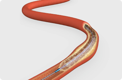 High Pressure PTA Balloon Catheter