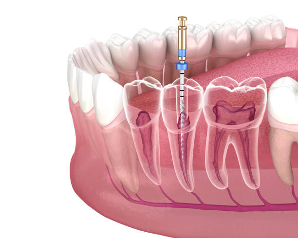 Endodontic Course