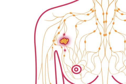 Breast Oncology Surgeons Los Angeles
