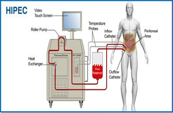 Hipec Treatment In India