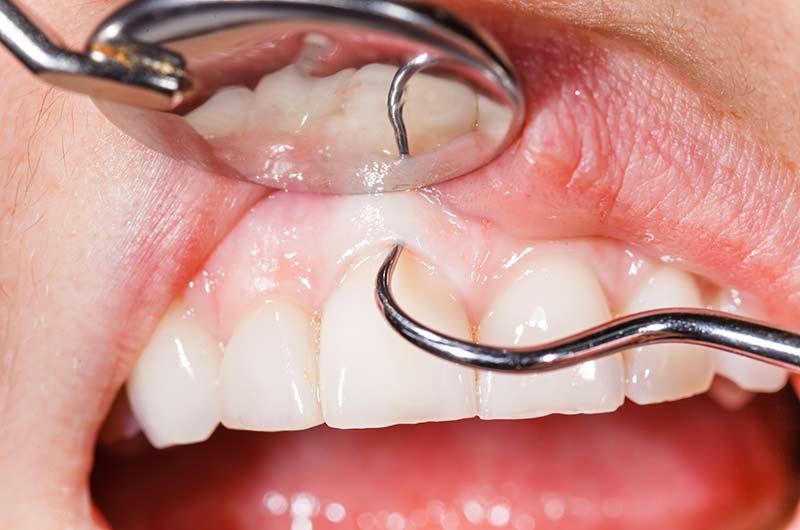 Periodontal Treatment